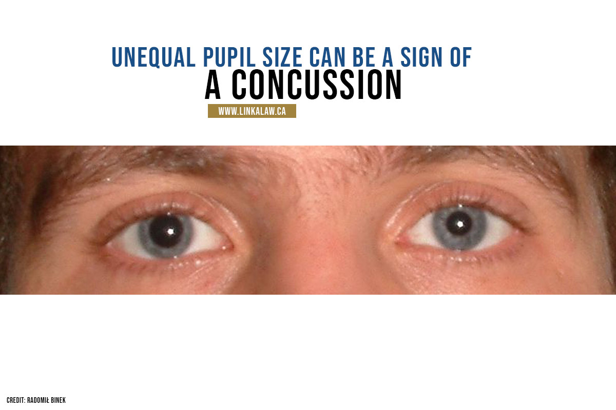 image of unequal pupil size